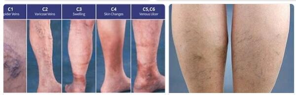 Circulatory Disorders and Varicose Veins in the Legs