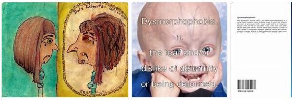 Dysmorphophobia