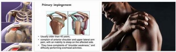 Impingement Syndrome